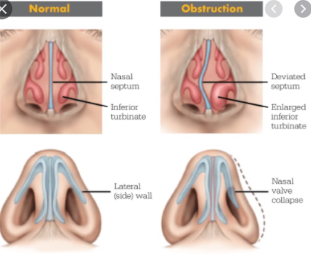 Illustration of the anatomy of the nose showing tissues that may be inflamed in  CRS